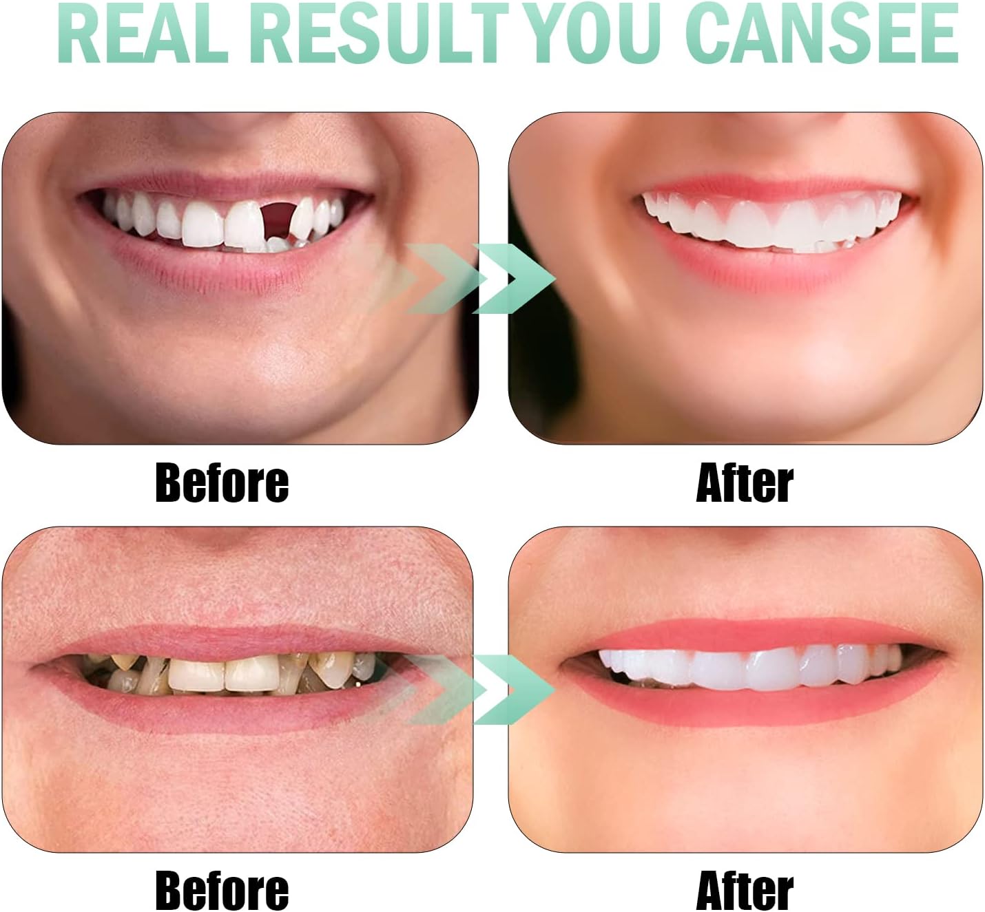 The A-List Snap On Veneers Instant Smile